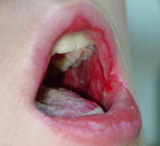 Mouth Cancer Mouth Cancer