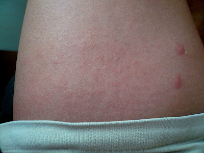 The hear rashes was all over heat rash on baby. The hear rashes was all over