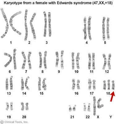 trisomy Trisomy Symptoms Diagnosis Treatment of Trisomy NY