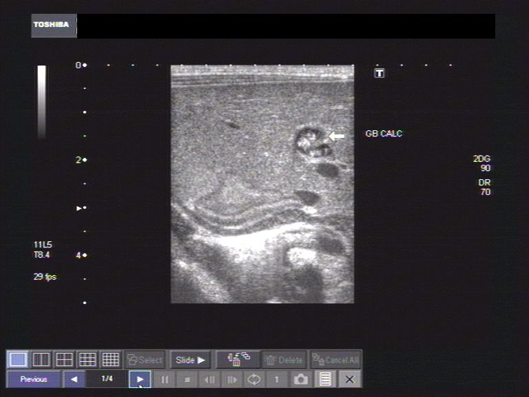 Not one stone, a gall bladder gallbladder stones ultrasound. Not one stone, a gall bladder