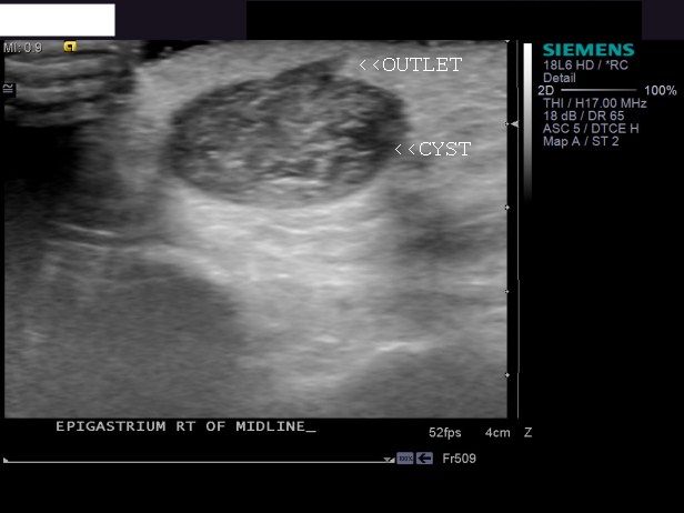 Ultrasound study of Sebaceous cyst: