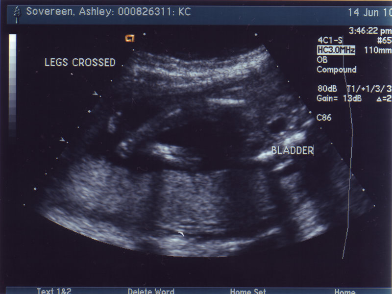 The Unwritten Chapters of Summer Girl Ultrasound Pictures