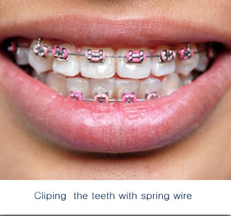 కట్టుడు పళ్ళు ఎందుకు? ,Use of Artificial teeth and dentures