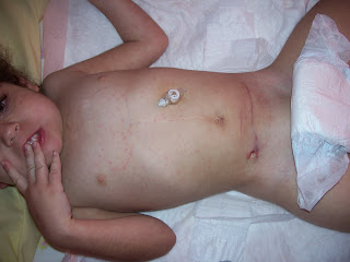 Lamictal Rash Pictures