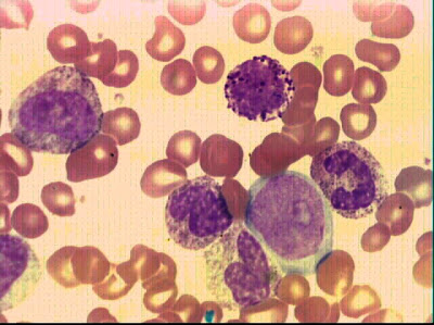 Die, cml cells, die!