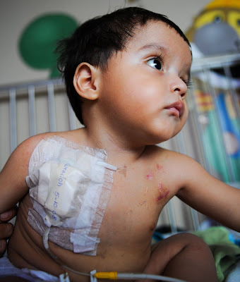 Children With Scars