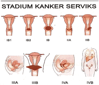 cancers cervical stadium