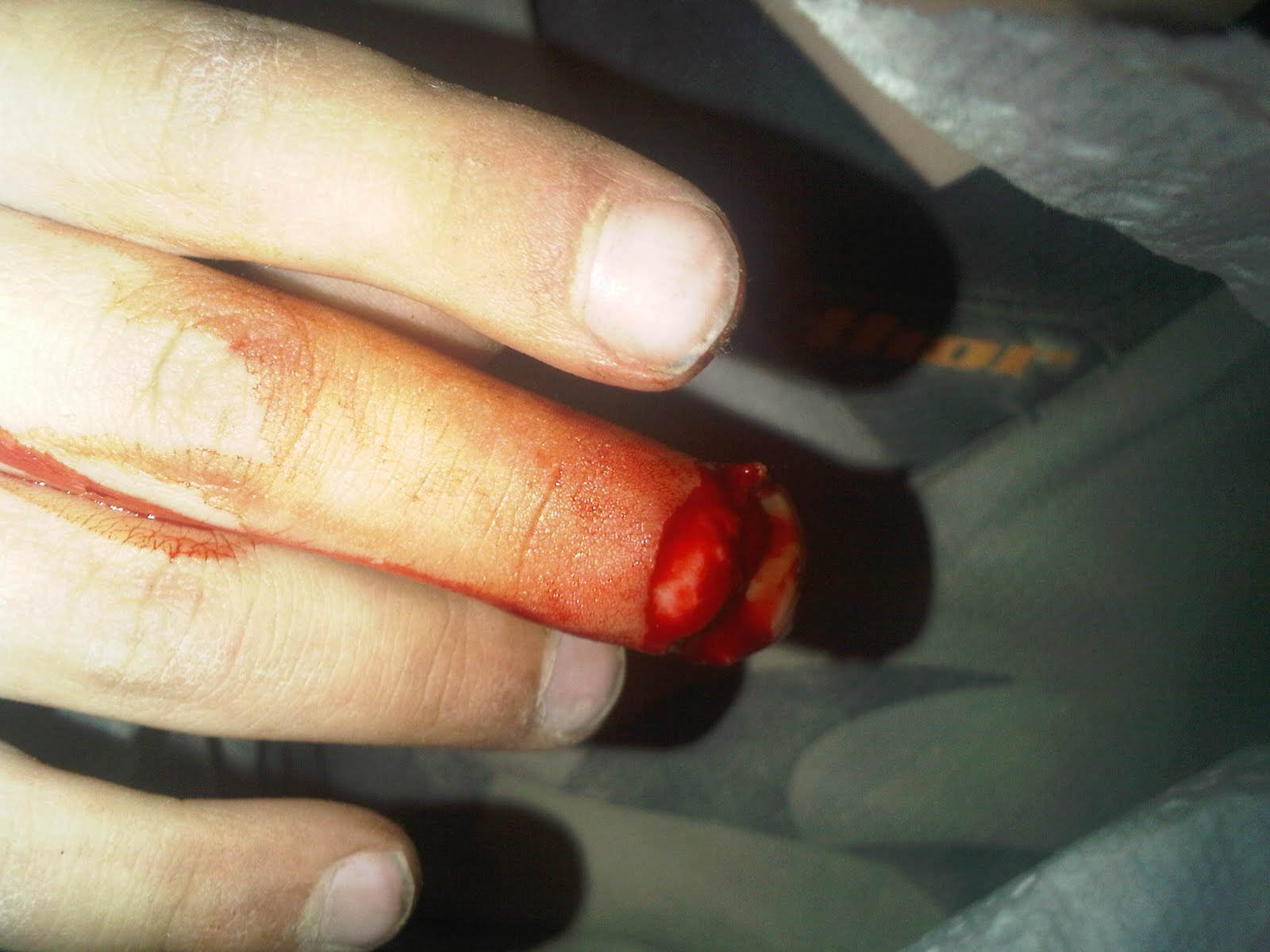 badly cut finger