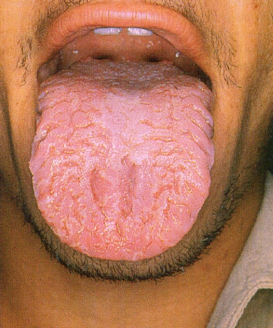 Lengua+Con+Grietas Lengua Fisurada: distribución de fisuras en el dorso de la lengua ...
