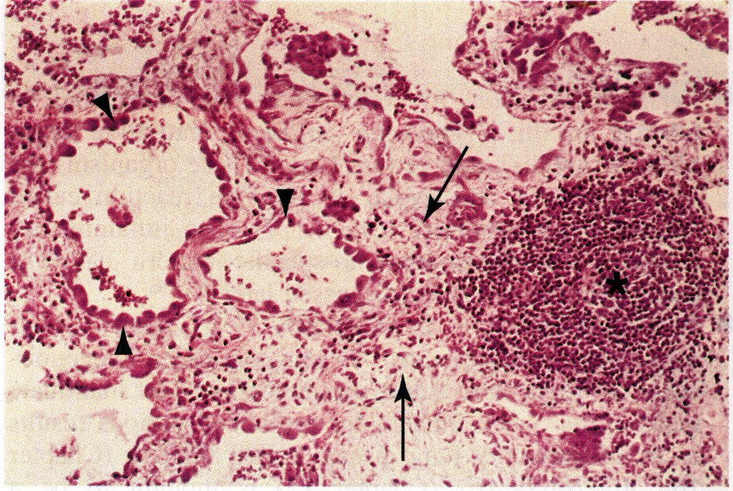 scar inflammation