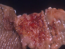 Necrosis coagulativa (intestino)