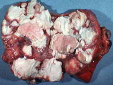 Necrosis licuefactiva (abscesos pulmonares)