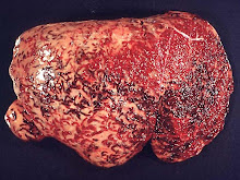 Fibrosis hepática (fasciolasis, cabra)