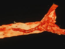 Trombosis en aorta (gato)