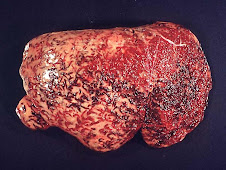 Fibrosis hepática (fasciolasis)