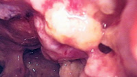 Diagnosis of Mesothelioma (Images)