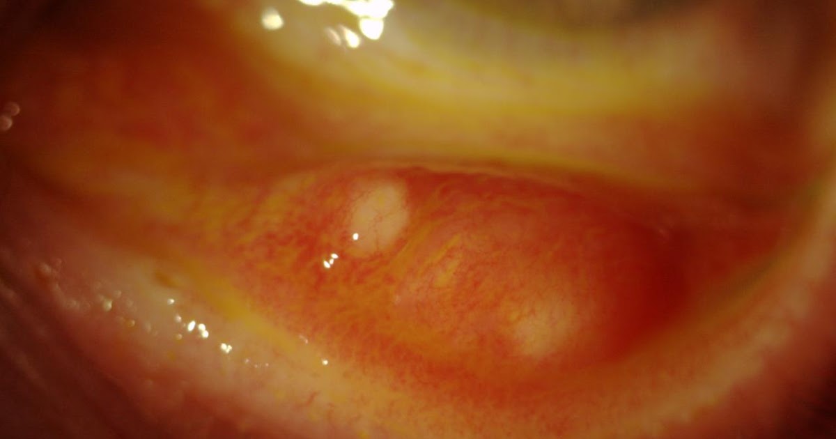 chalazion steroid injection chalazion steroid injection