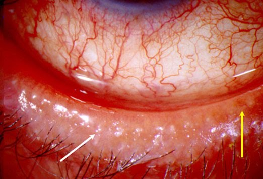 inflamed eyelash follicle