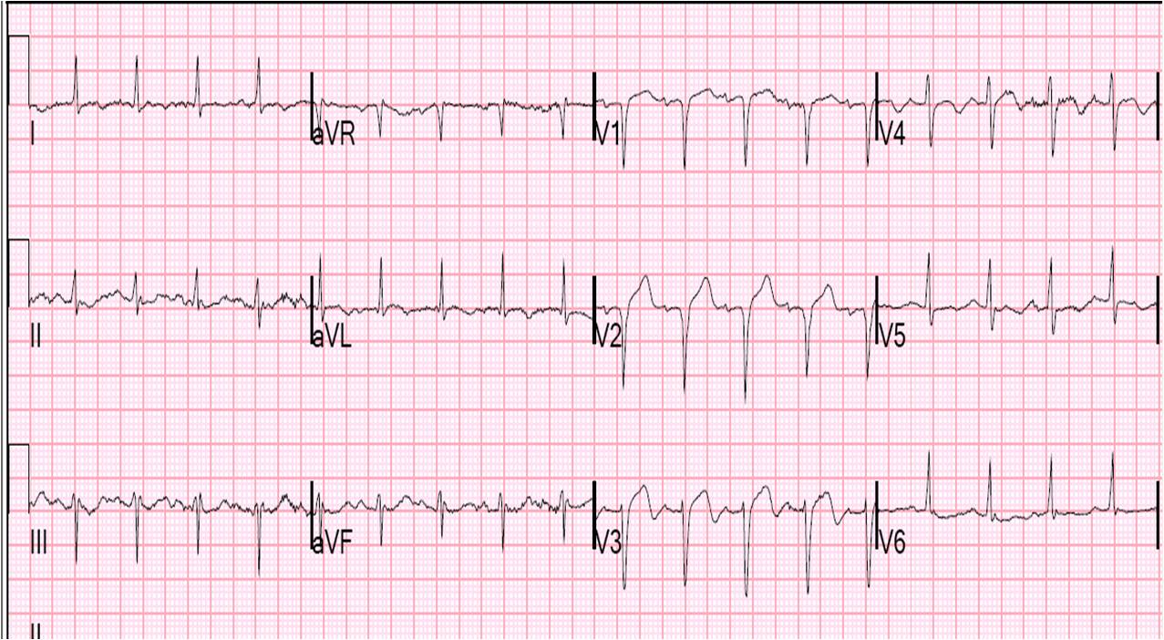 cardiogenic shock due to myocardial
