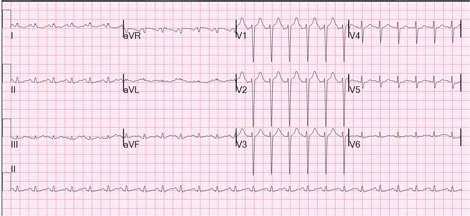 tako tsubo ecg