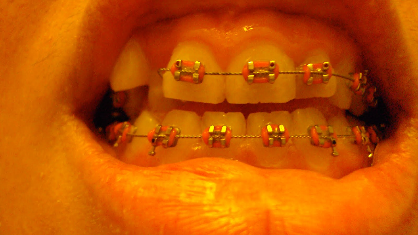 Grown up Brace Face Look, I have real braces now...Ouch!