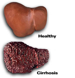 cirrhosis-liver.jpg