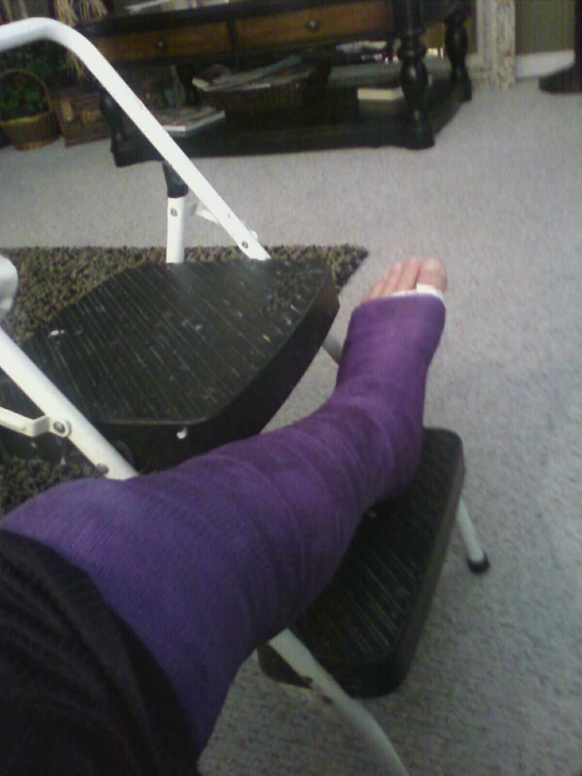 My Leg Cast