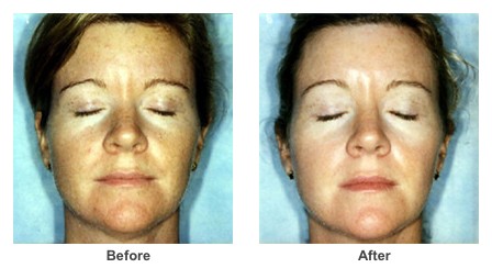 Rodan Fields Reverse
