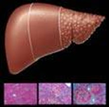 CIRROSIS, Evaluacion y Manejo Perioperatorio