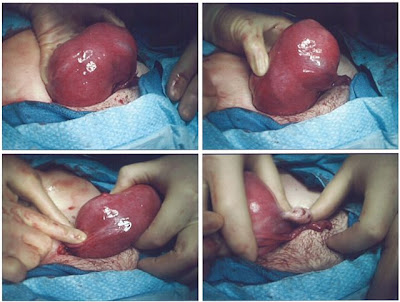 submucosal fibroid size submucosal fibroid size