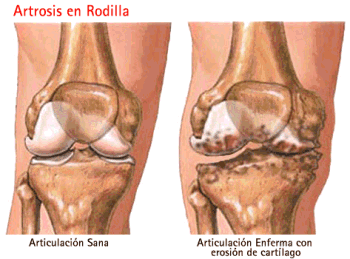 Gonartrosis o artrosis de rodilla ¿cómo aliviar el dolor?, Gonartrosis
