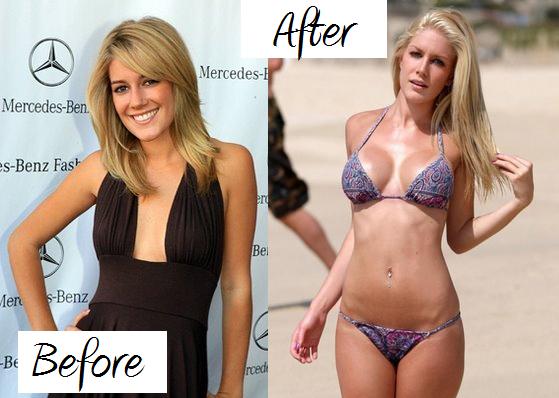 heidi montag before. heidi montag before after.