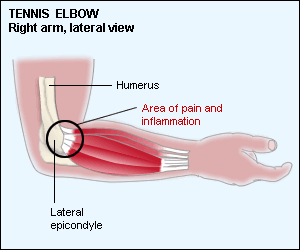 Psychology/Physio.blog: Tennis Elbow and Exercise Protocol