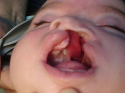 [Imagem: labio2.JPG]