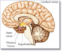 How To Treat Pituitary Tumors Naturally How To Treat Pituitary Tumors Naturally
