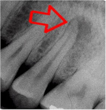 Periapical