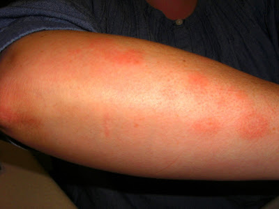 heat rashes on legs. of itchy skin rash on legs