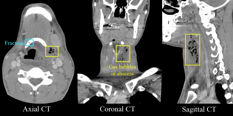 Bone Fracture-4.bp.blogspot.com Hyoid Bone Fracture