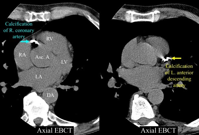 coronary artery calcifications on ct chest