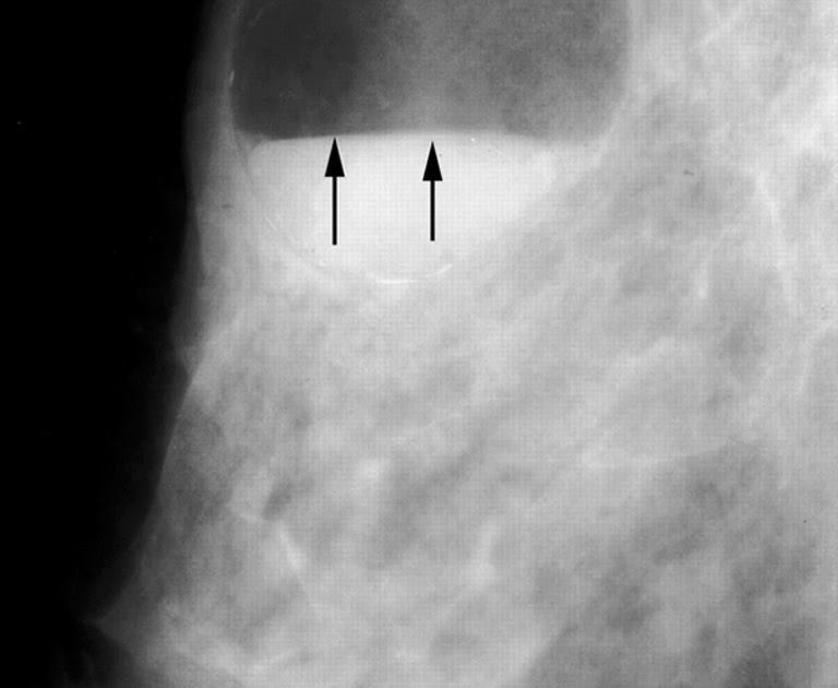 RadiologySpirit breast,galactocele