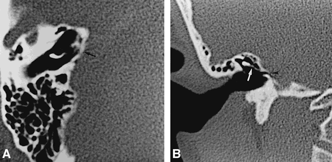 Cholesteatoma+ct+scan
