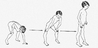 La lordosis lumbar natural