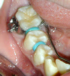 Mouth Spacers