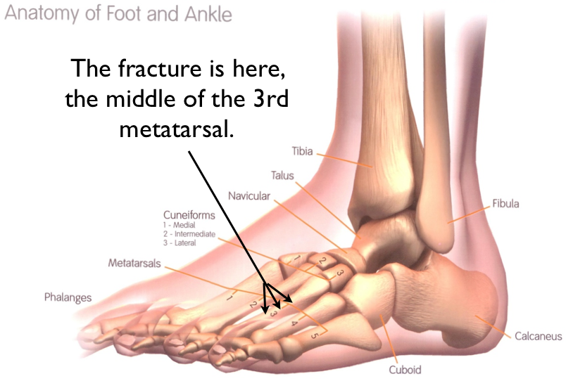 Metatarsal Bone Fracture Thursday, April 29, 2010-4.bp.blogspot.com