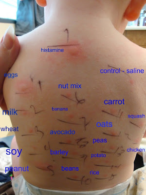 allergy patch tests food