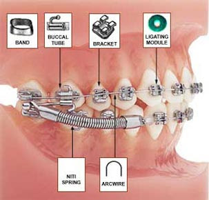 Archwire Braces