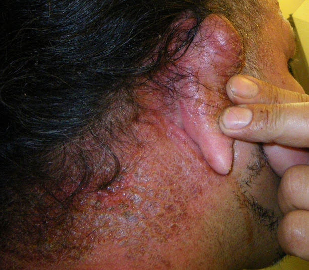 allergic reaction