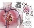 Cara Mengatasi dan Mencegah ANGINA PECTORIS (Angin Duduk)