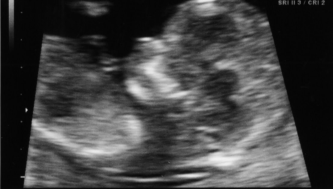 Baby Made 3. Add One More & You Have 4. A 156 BPM Heartbeat...