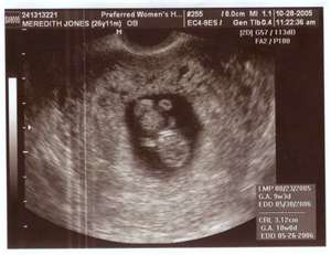 Blinded By The Light: Ultrasound During Pregnancy: Is it Really ... Blinded By The Light: Ultrasound During Pregnancy: Is it Really ...